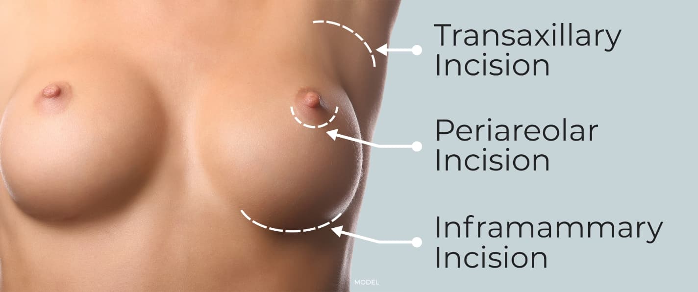Locations of transaxillary, periareolar, and inframammary incisions