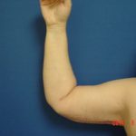 Photo by Dr. Lepore After Arm Lift