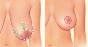 from: ASPS (Breast Lift Incision)