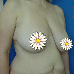 Breast reduction before
