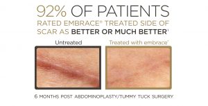 Embrace scar treatment before and after