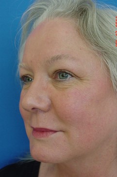 Radiesse After-photo by Dr. Lepore