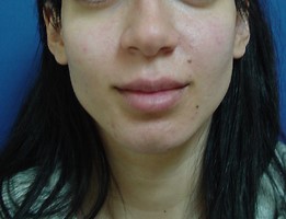 Voluma After-photo by Dr. Lepore
