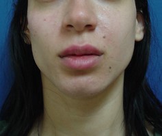 Voluma Before-photo by Dr. Lepore