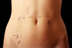 Woman with plastic surgery markings on abdomen