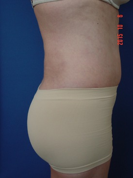 Liposuction after