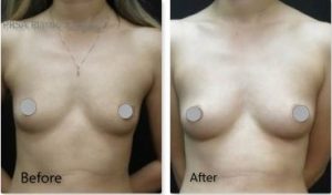 Fat Grafting to Breasts - Steven Bates MD