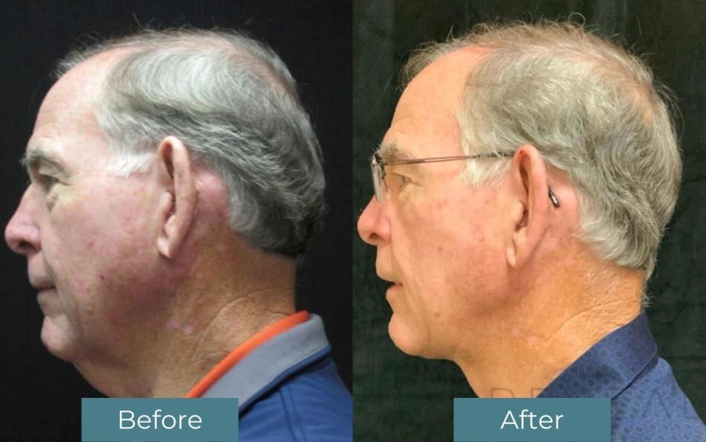 Before and after Neck Lift treatment on a gentleman at Reveal Plastic Surgery. Patient case #458
