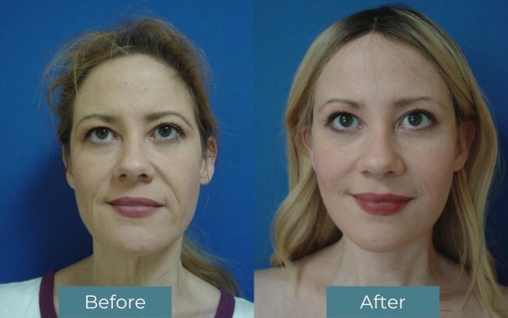 Before and after Facelift and Neck Lift treatment on a woman at Reveal Plastic Surgery. Patient case #381